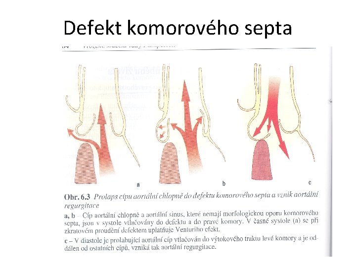 Defekt komorového septa 