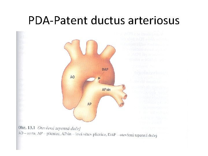 PDA-Patent ductus arteriosus 