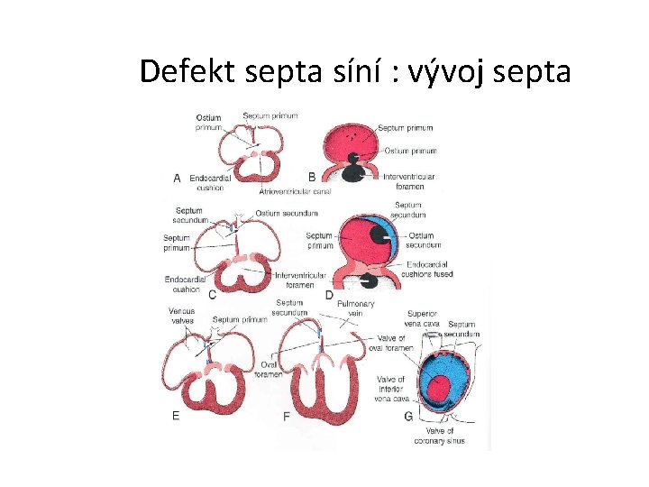 Defekt septa síní : vývoj septa 