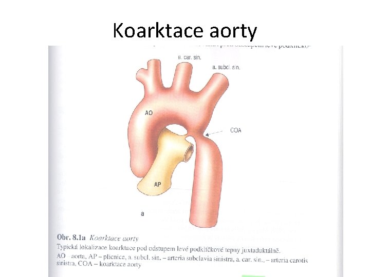 Koarktace aorty 