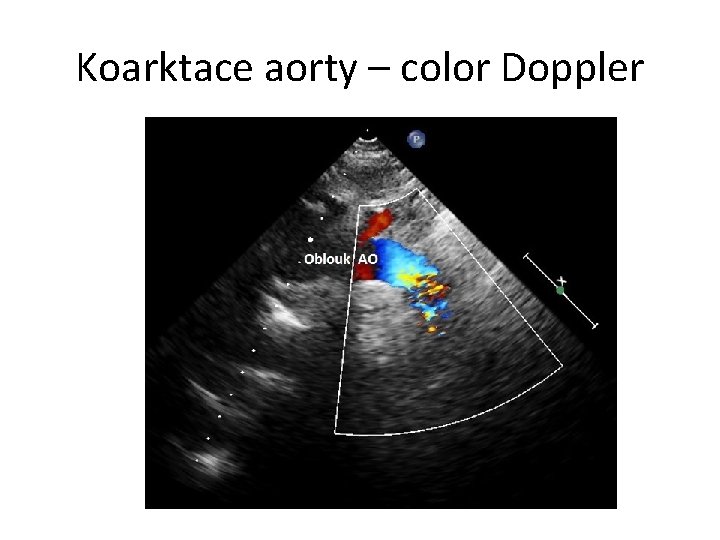 Koarktace aorty – color Doppler 