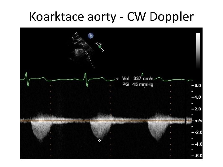 Koarktace aorty - CW Doppler 