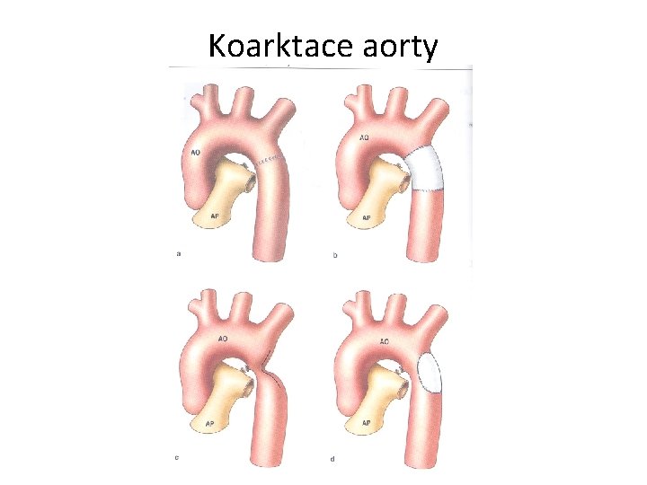 Koarktace aorty 
