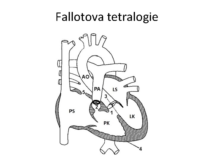 Fallotova tetralogie 