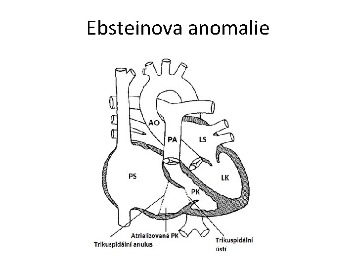 Ebsteinova anomalie 