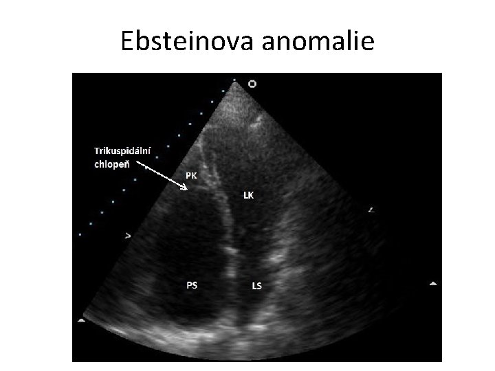 Ebsteinova anomalie 