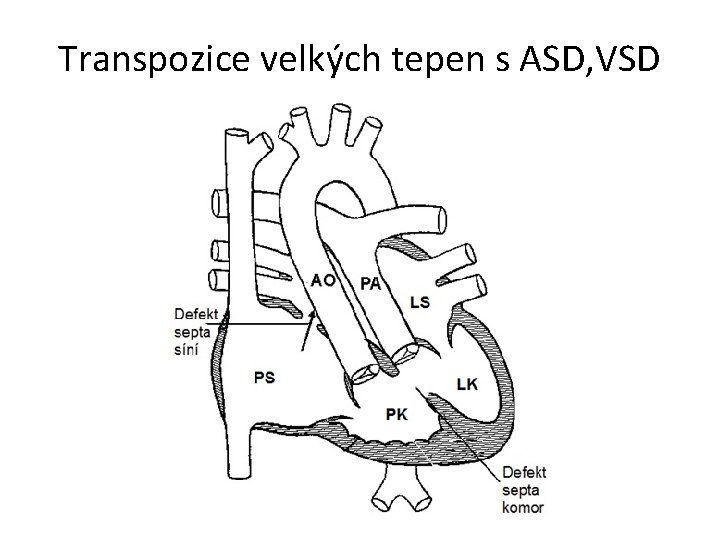 Transpozice velkých tepen s ASD, VSD 