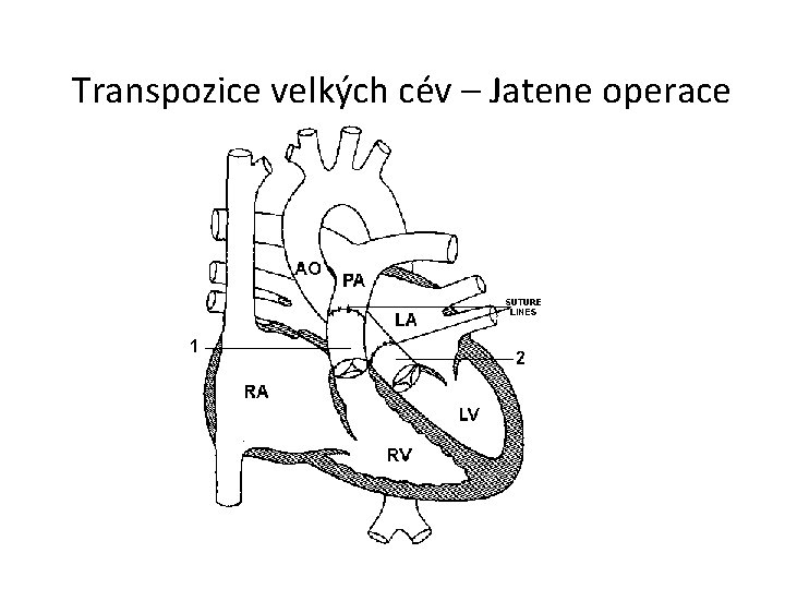 Transpozice velkých cév – Jatene operace 