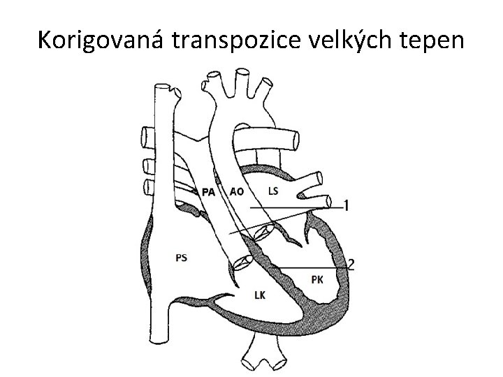 Korigovaná transpozice velkých tepen 