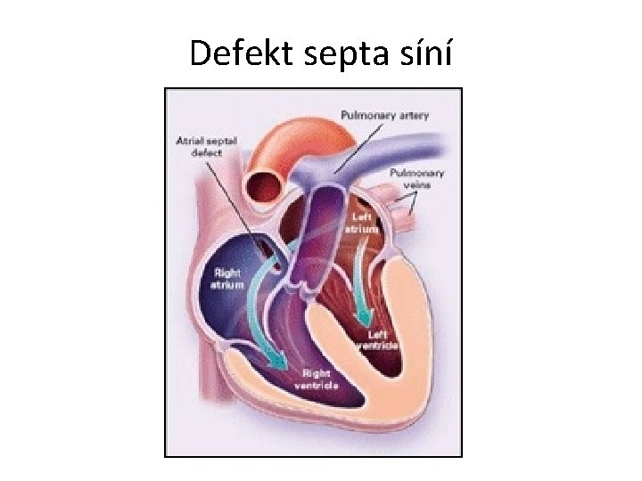 Defekt septa síní 