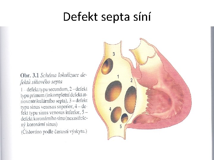 Defekt septa síní 