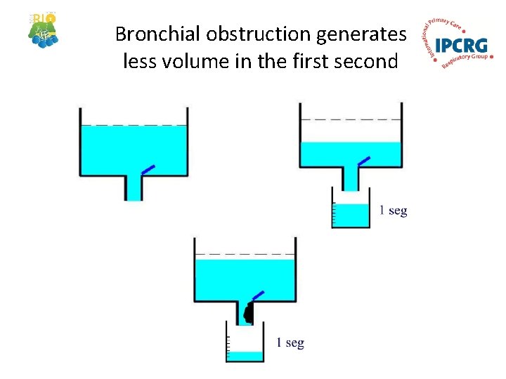 Bronchial obstruction generates less volume in the first second 