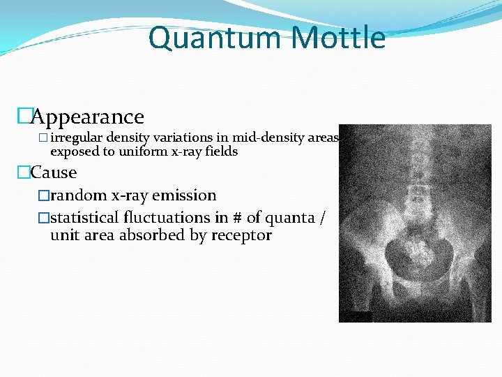 Quantum Mottle �Appearance � irregular density variations in mid-density areas exposed to uniform x-ray