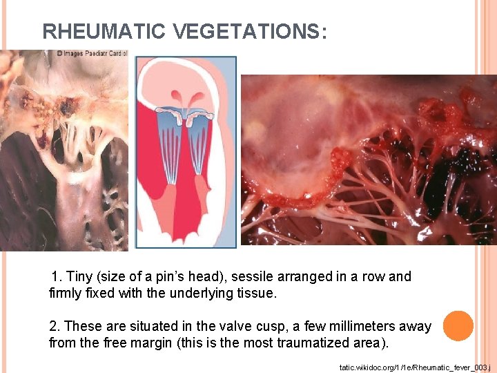 RHEUMATIC VEGETATIONS: 1. Tiny (size of a pin’s head), sessile arranged in a row