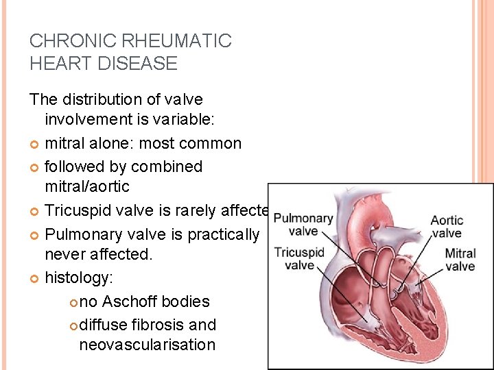 CHRONIC RHEUMATIC HEART DISEASE The distribution of valve involvement is variable: mitral alone: most
