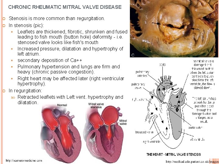 CHRONIC RHEUMATIC MITRAL VALVE DISEASE Stenosis is more common than regurgitation. In stenosis (pic):