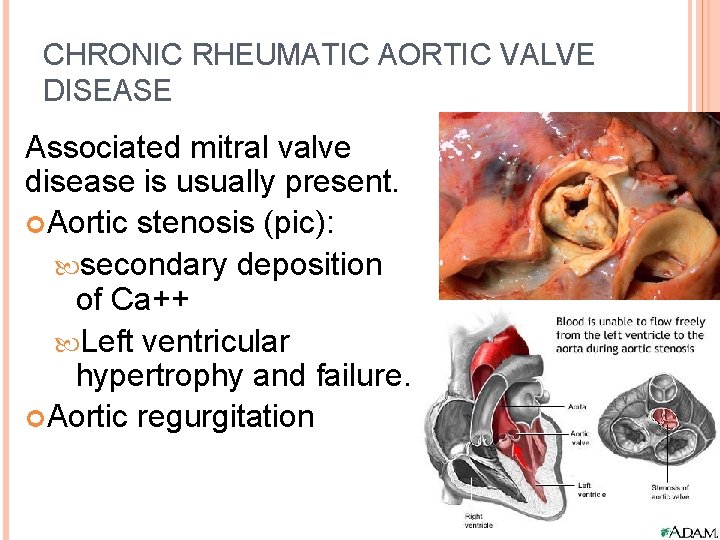 CHRONIC RHEUMATIC AORTIC VALVE DISEASE Associated mitral valve disease is usually present. Aortic stenosis