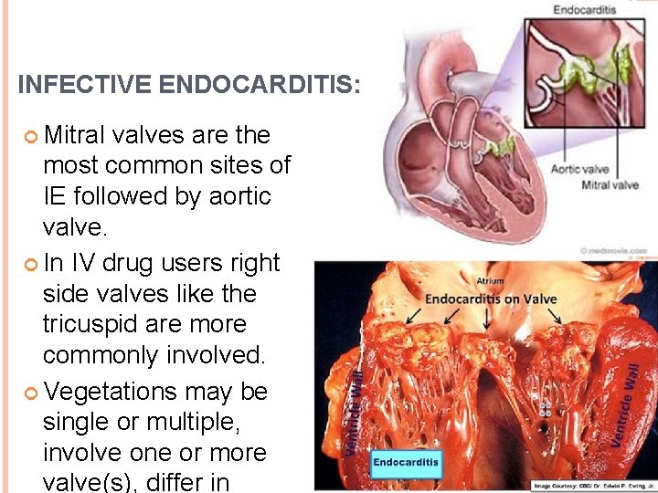 INFECTIVE ENDOCARDITIS: Mitral valves are the most common sites of IE followed by aortic
