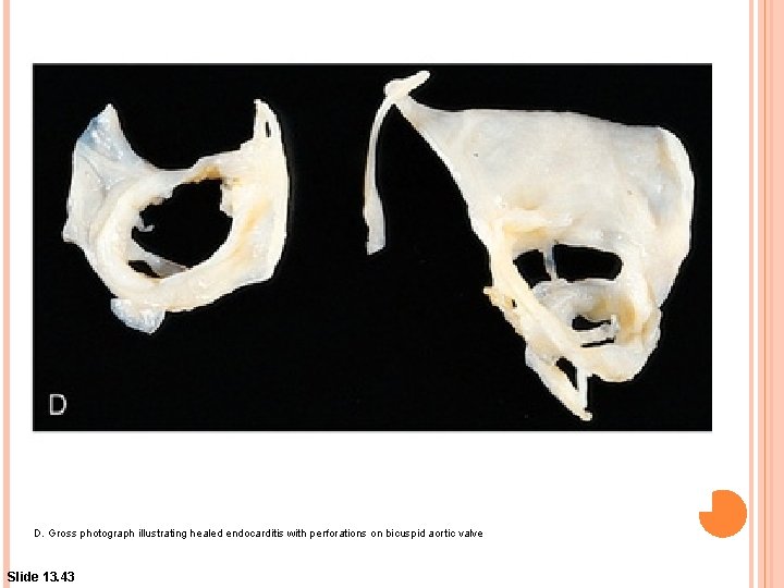 D. Gross photograph illustrating healed endocarditis with perforations on bicuspid aortic valve Slide 13.