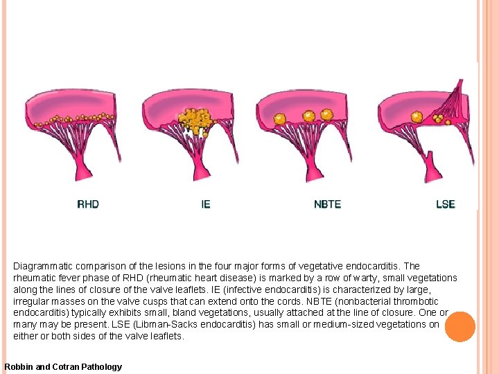 Diagrammatic comparison of the lesions in the four major forms of vegetative endocarditis. The