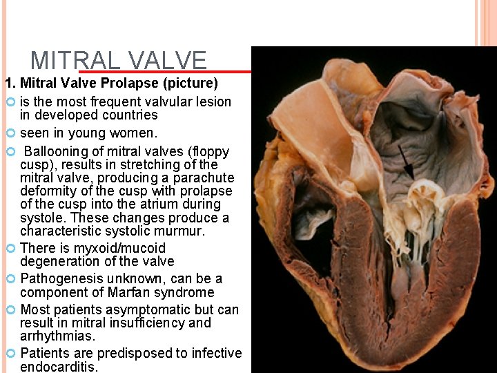 MITRAL VALVE 1. Mitral Valve Prolapse (picture) is the most frequent valvular lesion in