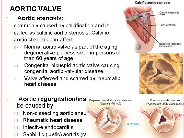 AORTIC VALVE 1. Aortic stenosis: commonly caused by calcification and is called as calcific
