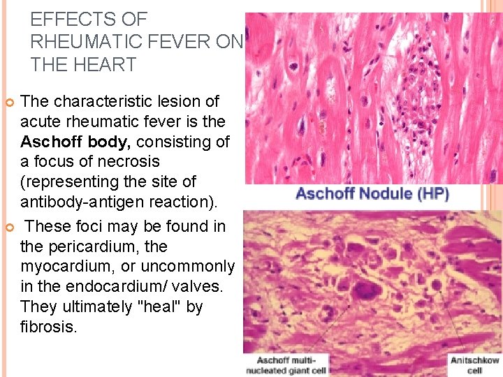 EFFECTS OF RHEUMATIC FEVER ON THE HEART The characteristic lesion of acute rheumatic fever