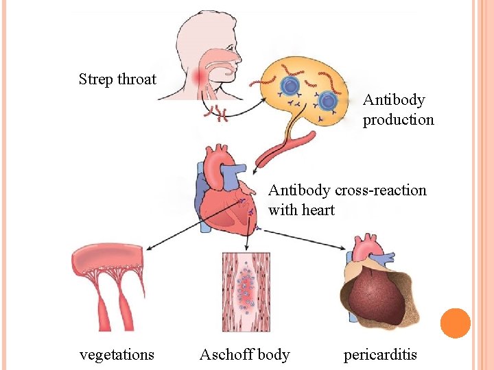 Strep throat Antibody production Antibody cross-reaction with heart vegetations Aschoff body pericarditis 
