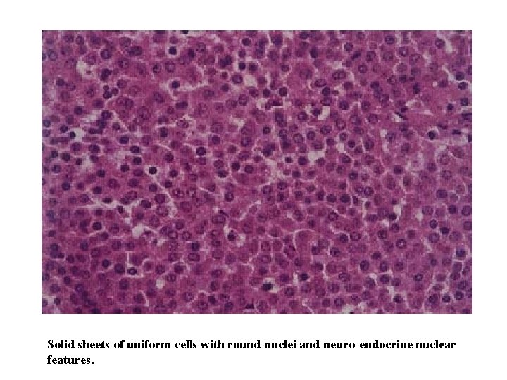 Solid sheets of uniform cells with round nuclei and neuro-endocrine nuclear features. 