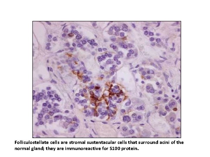 Folliculostellate cells are stromal sustentacular cells that surround acini of the normal gland; they