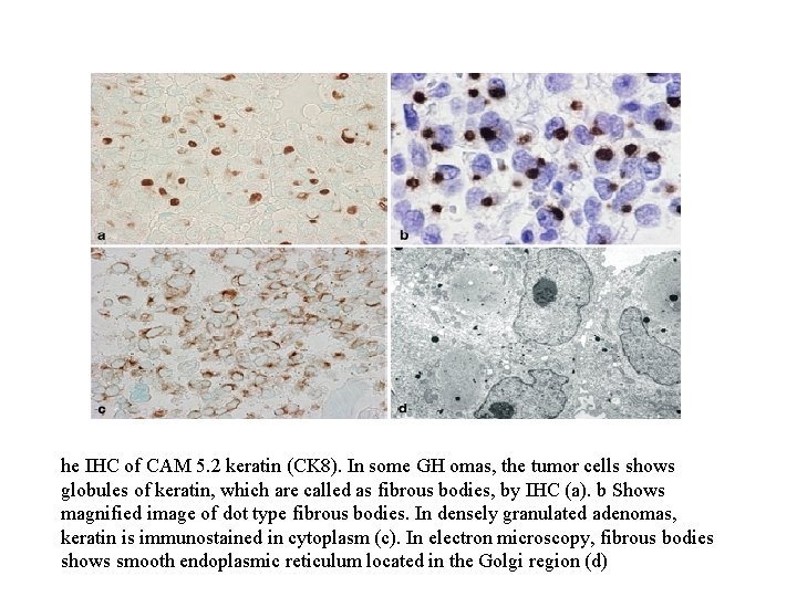 he IHC of CAM 5. 2 keratin (CK 8). In some GH omas, the