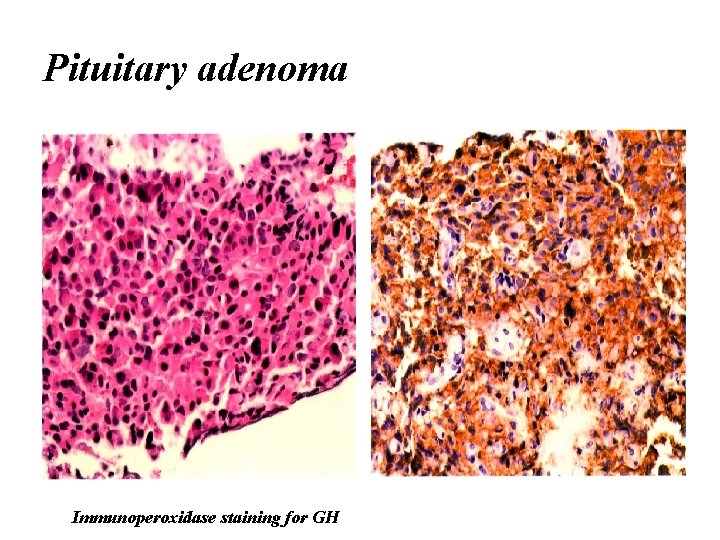 Pituitary adenoma Immunoperoxidase staining for GH 
