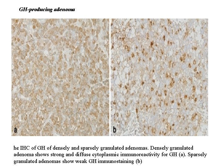 GH-producing adenoma he IHC of GH of densely and sparsely granulated adenomas. Densely granulated