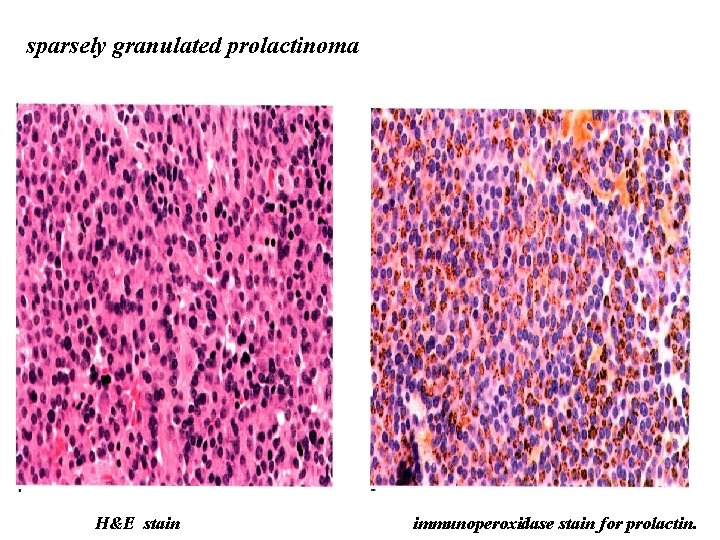 sparsely granulated prolactinoma H&E stain immunoperoxidase stain for prolactin. 