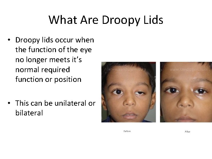 What Are Droopy Lids • Droopy lids occur when the function of the eye