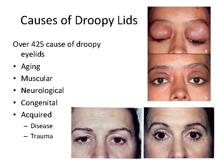 Causes of Droopy Lids Over 425 cause of droopy eyelids • Aging • Muscular