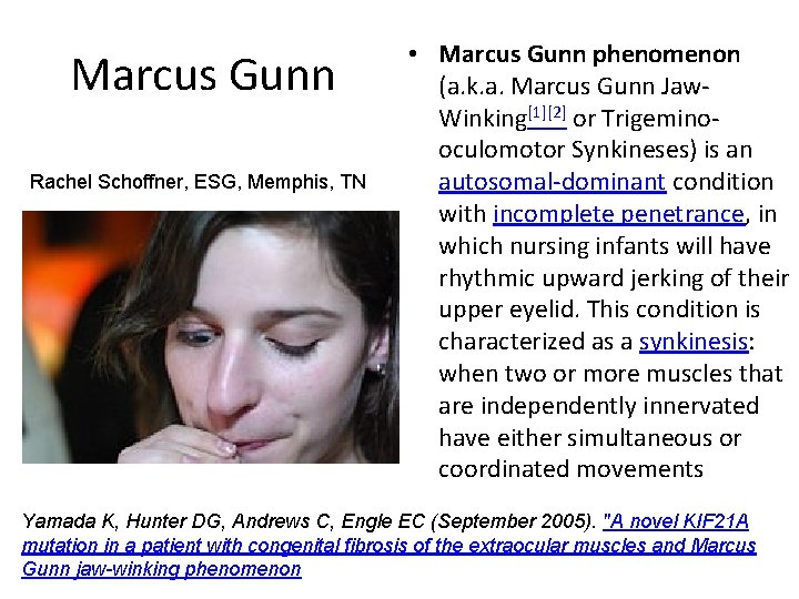 Marcus Gunn Rachel Schoffner, ESG, Memphis, TN • Marcus Gunn phenomenon (a. k. a.