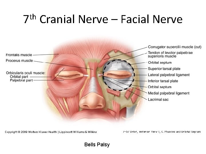 7 th Cranial Nerve – Facial Nerve Bells Palsy 