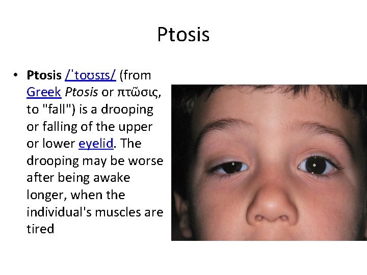 Ptosis • Ptosis /ˈtoʊsɪs/ (from Greek Ptosis or πτῶσις, to "fall") is a drooping