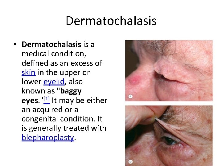 Dermatochalasis • Dermatochalasis is a medical condition, defined as an excess of skin in