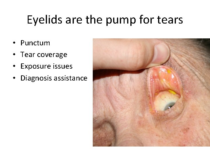 Eyelids are the pump for tears • • Punctum Tear coverage Exposure issues Diagnosis