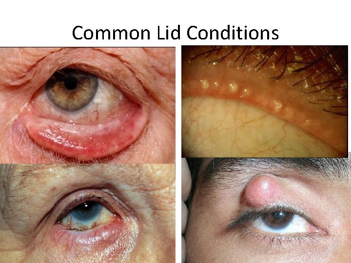 Common Lid Conditions 