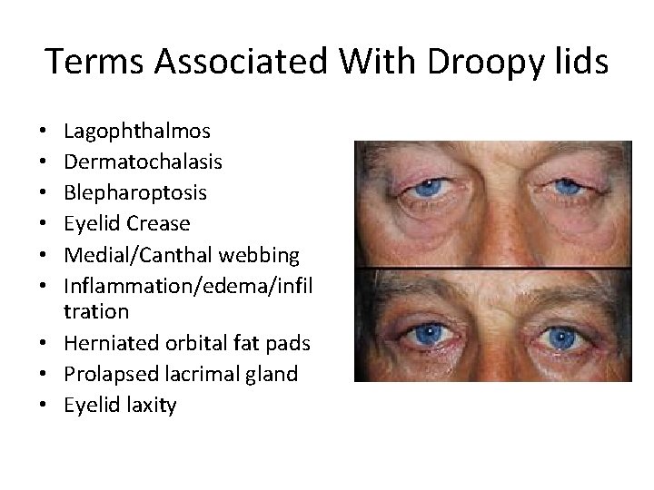 Terms Associated With Droopy lids Lagophthalmos Dermatochalasis Blepharoptosis Eyelid Crease Medial/Canthal webbing Inflammation/edema/infil tration