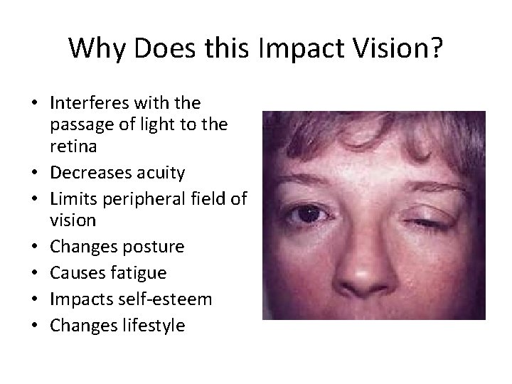 Why Does this Impact Vision? • Interferes with the passage of light to the