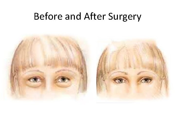 Before and After Surgery 