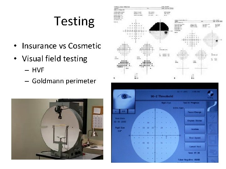 Testing • Insurance vs Cosmetic • Visual field testing – HVF – Goldmann perimeter