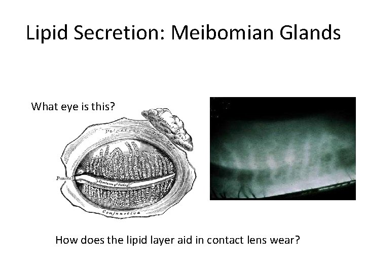 Lipid Secretion: Meibomian Glands What eye is this? (WC Posey, Diseases of the Eye,