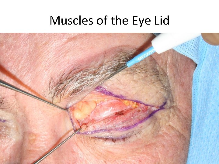 Muscles of the Eye Lid 