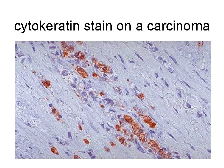 cytokeratin stain on a carcinoma 