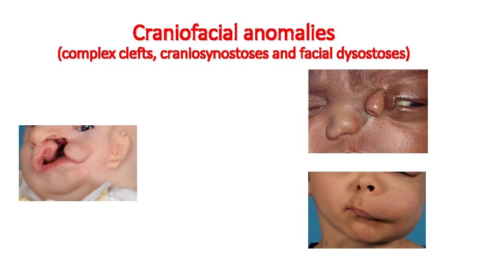 Craniofacial anomalies (complex clefts, craniosynostoses and facial dysostoses) 